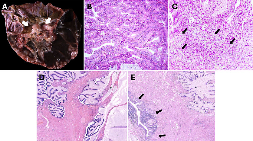 Pathology of Ovarian, Fallopian Tube and Primary Peritoneal